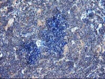 Immunohistochemistry: DUSP27/DUPD1 Antibody (OTI7E4) - Azide and BSA Free [NBP2-72503] - DUSP27/DUPD1 Antibody (7E4) Staining of paraffin-embedded Human lymphoma tissue using anti-DUSP27 mouse monoclonal antibody.