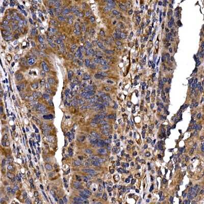 Immunohistochemistry-Paraffin: DYNC1LI2 Antibody [NBP3-16056] - Immunohistochemistry of paraffin-embedded human colon carcinoma using DYNC1LI2 Rabbit pAb (NBP3-16056) at dilution of 1:25 (40x lens).Perform high pressure antigen retrieval with 10 mM citrate buffer pH 6.0 before commencing with IHC staining protocol.