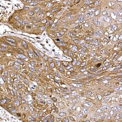 Immunohistochemistry-Paraffin: DYNC1LI2 Antibody [NBP3-16056] - Immunohistochemistry of paraffin-embedded human esophageal cancer using DYNC1LI2 Rabbit pAb (NBP3-16056) at dilution of 1:25 (40x lens).Perform high pressure antigen retrieval with 10 mM citrate buffer pH 6.0 before commencing with IHC staining protocol.