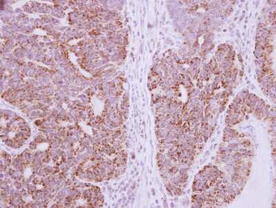 Immunohistochemistry-Paraffin: DcR3 Antibody [NBP2-16113] - Immunohistochemical analysis of paraffin-embedded Colon CA, using antibody at 1:250 dilution.