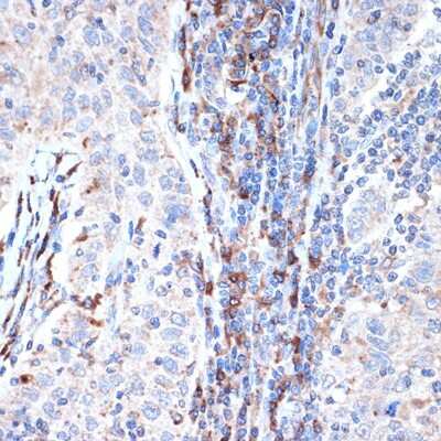 Immunohistochemistry-Paraffin: Dcp1a Antibody (7Q8Q6) [NBP3-16644] - Immunohistochemistry of paraffin-embedded human esophageal cancer using Dcp1a Rabbit mAb (NBP3-16644) at dilution of 1:100 (40x lens).Perform microwave antigen retrieval with 10 mM Tris/EDTA buffer pH 9.0 before commencing with IHC staining protocol.