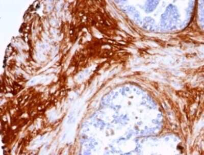 Immunohistochemistry-Paraffin: Decorin Antibody (DCN/7031R) [NBP3-13862] - Formalin-fixed, paraffin-embedded human prostate carcinoma stained with Decorin antibody (DCN/7031R).