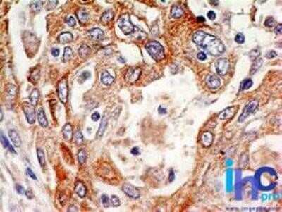 Immunohistochemistry-Paraffin: Delta Np73 Antibody (38C674.2) - Azide Free [NBP2-33262] - Delta Np73 Antibody (38C674.2) Formalin-fixed, paraffin-embedded lung squamous cell carcinoma probed with p73 antibody at 5 ug/ml. Image from the standard format of this antibody.
