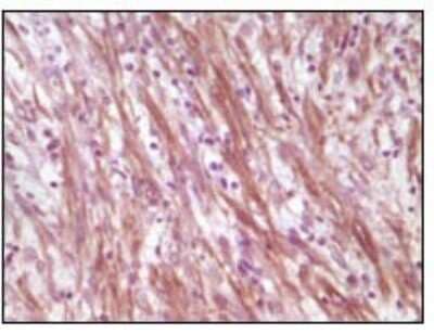 Immunohistochemistry-Paraffin: Desmin Antibody (10H7D2) [NB110-60508] - Analysis of human smooth musde sarcoma, showing cytoplasmic localization using Desmin mouse mAb with DAB staining.