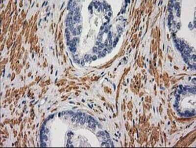 Immunohistochemistry: Desmin Antibody (OTI4G1) - Azide and BSA Free [NBP2-70565] - Staining of paraffin-embedded Carcinoma of Human prostate tissue using anti-Desmin mouse monoclonal antibody.