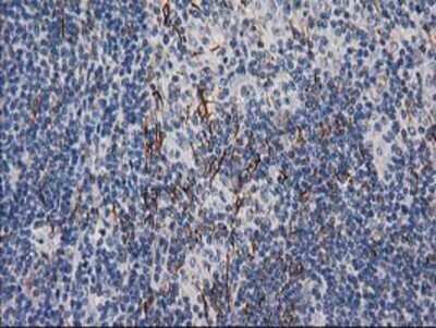Immunohistochemistry: Desmin Antibody (OTI4G1) - Azide and BSA Free [NBP2-70565] - Staining of paraffin-embedded Human lymphoma tissue using anti-Desmin mouse monoclonal antibody.