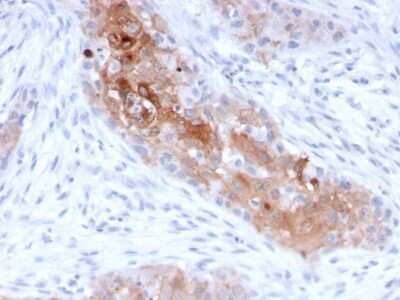 Immunohistochemistry-Paraffin: Desmoglein-1 Antibody (32-2B) - Azide and BSA Free [NBP3-08662] - Formalin-fixed, paraffin-embedded human Bladder Carcinoma stained with Desmoglein-1 Mouse Monoclonal Antibody (32-2B).