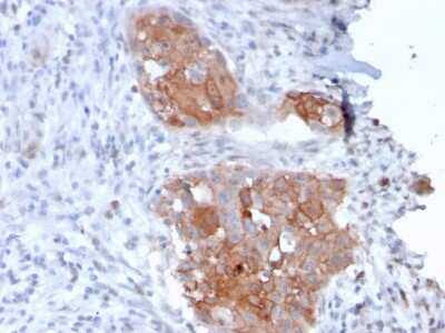 Immunohistochemistry-Paraffin: Desmoglein-1 Antibody (32-2B) - Azide and BSA Free [NBP3-08662] - Formalin-fixed, paraffin-embedded human Bladder Carcinoma stained with Desmoglein-1 Mouse Monoclonal Antibody (32-2B).