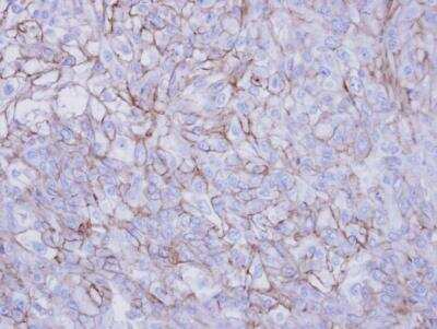 Immunohistochemistry-Paraffin: Desmoglein-2 Antibody [NBP1-33374] - DU145 xenograft , using Desmoglein-2  antibody at 1:100 dilution. Antigen Retrieval: Trilogy™ (EDTA based, pH 8.0) buffer, 15min. 