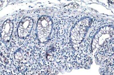 Immunohistochemistry-Paraffin: Desmoglein-2 Antibody [NBP1-33374] - Human colon cancer. Desmoglein 2 stained by Desmoglein 2 antibody [N1N2], N-term  diluted at 1:500. Antigen Retrieval: Citrate buffer, pH 6.0, 15 min. 