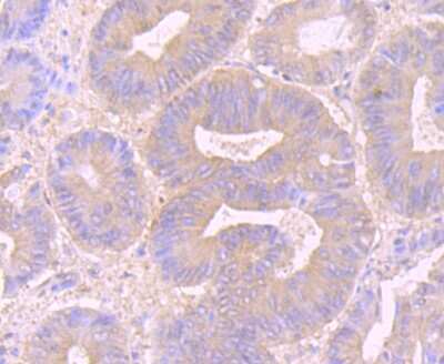Immunohistochemistry-Paraffin: Desmoglein-2 Antibody (JB96-37) [NBP2-75469] - Analysis of paraffin-embedded human colon cancer tissue using anti-Desmoglein 2 antibody. Counter stained with hematoxylin.