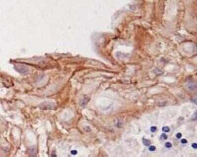 Immunocytochemistry: Desmoglein-3 Antibody (5G11) - Azide and BSA Free [NBP2-80694] - Analysis of Desmoglein-3 on human skin cancer. NB100-1643 was used at a dilution of 1:200. Image from the standard format of this antibody.