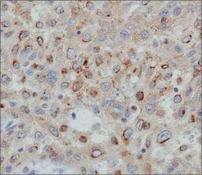 Immunohistochemistry: Desmoglein-3 Antibody (5H10) - Azide and BSA Free [NBP2-80695] - Analysis of Desmoglein 3 on human skin cancer using NBP1-78984. Image from the standard format of this antibody.