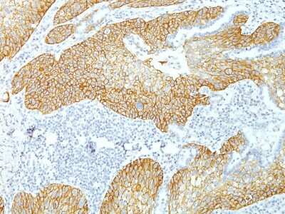 Immunohistochemistry-Paraffin: Desmoglein-3 Antibody (DSG3/1535) [NBP3-07873] - Formalin-fixed, paraffin-embedded human Lung Squamous Cell Carcinoma stained with Desmoglein-3 Monoclonal Antibody (DSG3/1535).