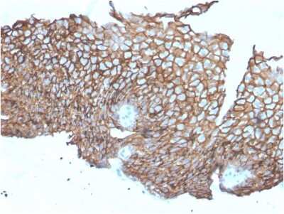 Immunohistochemistry-Paraffin: Desmoglein-3 Antibody (DSG3/2840) [NBP3-08509] - Formalin-fixed, paraffin-embedded human Esophageal Carcinoma stained with Desmoglein-3 Mouse Monoclonal Antibody (DSG3/2840).