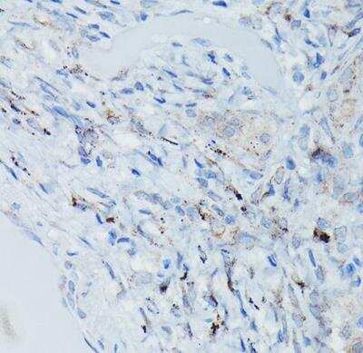 Immunohistochemistry-Paraffin: Dfna5 Antibody [NBP2-92914] - Human pulmonary tuberculosis using DFNA5/GSDME Rabbit pAb at dilution of 1:50 (40x lens).