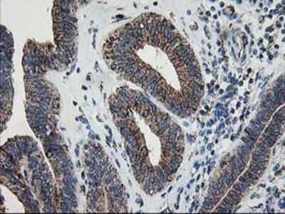 Immunohistochemistry: Dihydrolipoamide Dehydrogenase/DLD Antibody (OTI6D5) - Azide and BSA Free [NBP2-70574] - Staining of paraffin-embedded Adenocarcinoma of Human endometrium tissue using anti-Lipoamide Dehydrogenase mouse monoclonal antibody.