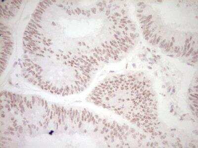 Immunohistochemistry-Paraffin: Dishevelled-2 Antibody (2D11) [NBP2-46480] - Analysis of Adenocarcinoma of Human colon tissue. (Heat-induced epitope retrieval by 1 mM EDTA in 10mM Tris, pH8.5, 120 degrees C for 3min)