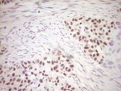 Immunohistochemistry-Paraffin: Dishevelled-2 Antibody (2D11) [NBP2-46480] - Analysis of Carcinoma of Human kidney tissue. (Heat-induced epitope retrieval by 1 mM EDTA in 10mM Tris, pH8.5, 120C for 3min)