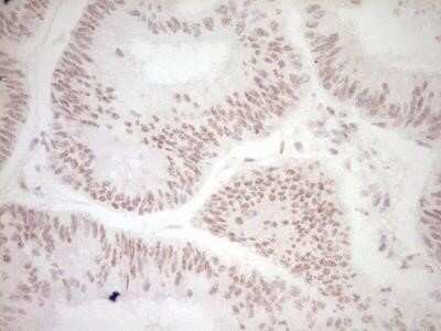 Immunohistochemistry: Dishevelled-2 Antibody (OTI2D11) - Azide and BSA Free [NBP2-70611] - Analysis of Adenocarcinoma of Human colon tissue. (Heat-induced epitope retrieval by 1 mM EDTA in 10mM Tris, pH8.5, 120 degrees C for 3min)