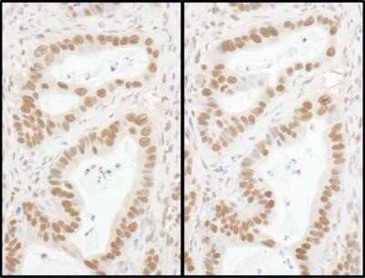 Immunohistochemistry-Paraffin: Donkey anti-Goat IgG (H+L) Secondary Antibody [HRP] [NB7357] - Detection of human Sp1 by immunohistochemistry. Sample: FFPE section of human stomach carcinoma. Antibody: Affinity purified rabbit anti-Sp1 [NBP2-22296] used at a dilution of 1:5,000 (0.2ug/ml). Secondary Antibody: Donkey anti-Goat IgG (H+L) Secondary Antibody [HRP] [NB7357] lot 23 (left) and lot 24 (right) used at a dilution of 1:200 (5ug/ml). Detection: DAB