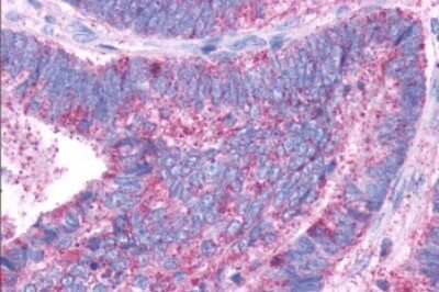 Immunohistochemistry-Paraffin: Dopamine D1 R/DRD1 Antibody [NLS44] - Anti-DRD1 / Dopamine Receptor D1 antibody IHC of human Colon, Carcinoma. Immunohistochemistry of formalin-fixed, paraffin-embedded tissue after heat-induced antigen retrieval.