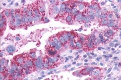 Immunohistochemistry-Paraffin: Dopamine D1 R/DRD1 Antibody [NLS44] - Anti-DRD1 / Dopamine Receptor D1 antibody IHC of human Lung, Adenocarcinoma. Immunohistochemistry of formalin-fixed, paraffin-embedded tissue after heat-induced antigen retrieval.