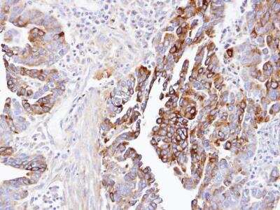 Immunohistochemistry-Paraffin: Dynactin Subunit 1/DCTN1 Antibody [NBP1-30880] -  Paraffin-embedded OVCA, using antibody at 1:100 dilution.