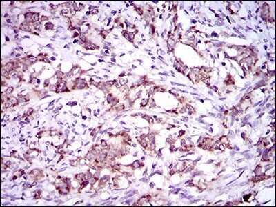 Immunohistochemistry: Dynein light chain 4 Antibody (3C10A4) [NBP2-37389] - Immunohistochemical analysis of paraffin-embedded cervical cancer tissues using DNAL4 mouse mAb with DAB staining.