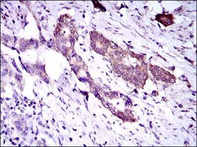 Immunohistochemistry: Dynein light chain 4 Antibody (3C10A4) [NBP2-37389] - Immunohistochemical analysis of paraffin-embedded esophageal cancer tissues using DNAL4 mouse mAb with DAB staining.