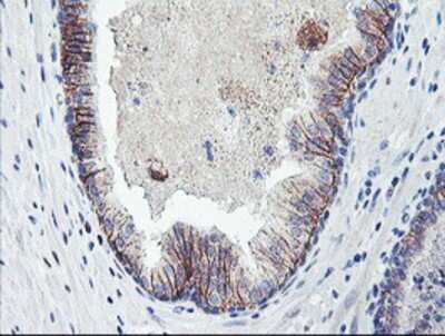Immunohistochemistry-Paraffin: Dystrobrevin beta Antibody (3A12) [NBP2-01798] - Staining of paraffin-embedded Carcinoma of Human prostate tissue using anti-Dystrobrevin beta mouse monoclonal antibody.