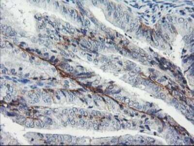 Immunohistochemistry: Dystrobrevin beta Antibody (OTI3A12) - Azide and BSA Free [NBP2-70598] - Staining of paraffin-embedded Adenocarcinoma of Human endometrium tissue using anti-Dystrobrevin beta mouse monoclonal antibody.