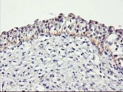 Immunohistochemistry: Dystrobrevin beta Antibody (OTI3A12) - Azide and BSA Free [NBP2-70598] - Staining of paraffin-embedded Carcinoma of Human bladder tissue using anti-Dystrobrevin beta mouse monoclonal antibody.
