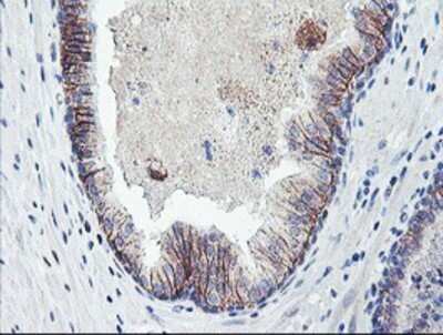 Immunohistochemistry: Dystrobrevin beta Antibody (OTI3A12) - Azide and BSA Free [NBP2-70598] - Staining of paraffin-embedded Carcinoma of Human prostate tissue using anti-Dystrobrevin beta mouse monoclonal antibody.