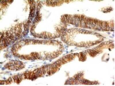 Immunohistochemistry-Paraffin: E-Cadherin Antibody (CDH1/1525) - Azide and BSA Free [NBP2-54551] - Formalin-fixed, paraffin-embedded human Colon Carcinoma stained with E-Cadherin Monoclonal Antibody (CDH1/1525).