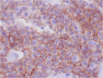 Immunohistochemistry-Paraffin: E-Cadherin Antibody (CDH1/1525) - Azide and BSA Free [NBP2-54551] - Formalin-fixed, paraffin-embedded human breast adenocarcinoma stained with E-Cadherin Mouse Monoclonal Antibody (CDH1/1525).