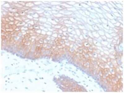 Immunohistochemistry-Paraffin: E-Cadherin Antibody (CDH1/2208R) [NBP3-07902] - Formalin-fixed, paraffin-embedded human Colon Carcinoma stained with E-Cadherin Rabbit Recombinant Monoclonal Antibody (CDH1/2208R).