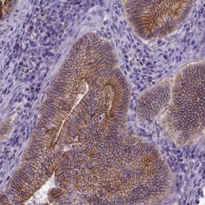 Immunohistochemistry-Paraffin: E-Cadherin Antibody (CL1180) [NBP2-34477] - Staining of human colorectal cancer shows strong membranous positivity in tumor cells.