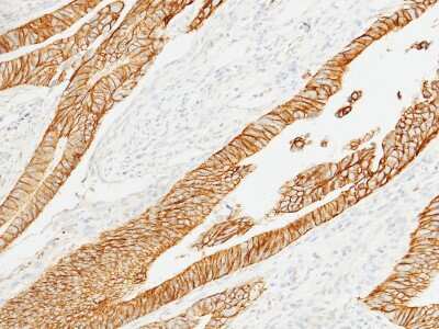 Immunohistochemistry-Paraffin: E-Cadherin Antibody [NBP2-99061] - Immunochemical staining of human E-Cadherin in human colon carcinoma with rabbit polyclonal antibody (1:1000, formalin-fixed paraffin embedded sections).