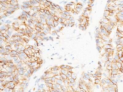 Immunohistochemistry-Paraffin: E-Cadherin Antibody [NBP2-99061] - Immunochemical staining of human E-Cadherin in human gastric cancer with rabbit polyclonal antibody (1:1000, formalin-fixed paraffin embedded sections).