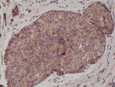 Immunohistochemistry-Paraffin: E-Cadherin Antibody (RM244) [NBP2-61468] - Immunohistochemical staining of formalin fixed and paraffin embedded human breast cancer tissue sections using NBP2-61468.