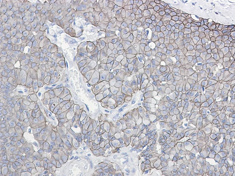 Immunohistochemistry-Paraffin: E-Cadherin [p Ser838, p Ser840] Antibody (S03-3B3) [NBP3-19826] - Immunohistochemistry of E-Cadherin (phospho-Ser838/Ser840) in paraffin-embedded Human breast cancer tissue using NBP3-19826 at dilution 1/50