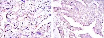 Immunohistochemistry: E7 Antibody (6F3) [NBP2-37628] - Immunohistochemical analysis of paraffin-embedded placenta tissues (left) and ovarian cancer (right) using E7 mouse mAb with DAB staining.