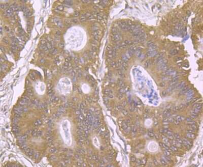 Immunohistochemistry-Paraffin: EAAT3 Antibody (JU39-69) [NBP2-75476] - Analysis of paraffin-embedded human colon cancer tissue using anti-EAAT3 antibody. Counter stained with hematoxylin.