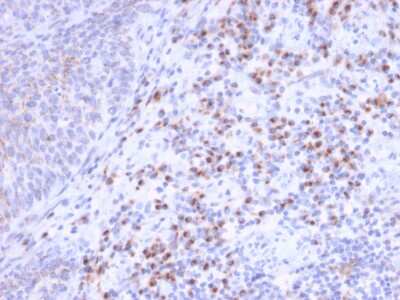 Immunohistochemistry-Paraffin: EBAG9/RCAS1 Antibody (CPTC-EBAG9-1) - Azide and BSA Free [NBP3-08859] - Formalin-fixed, paraffin-embedded human Unknown Tumor stained with EBAG9/RCAS1 Mouse Monoclonal Antibody (CPTC-EBAG9-1).
