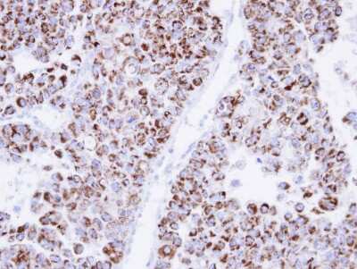 Immunohistochemistry-Paraffin: ECH1 Antibody [NBP1-31662] - Paraffin-embedded OV90 xenograft, using antibody at 1:500 dilution.