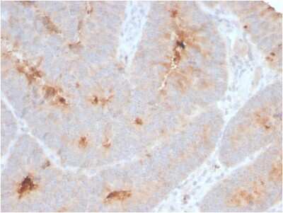 Immunohistochemistry-Paraffin: ECM-1/Secretory Component P85 Antibody (ECM1/2889R) [NBP3-07295] - Formalin-fixed, paraffin-embedded human Colon Carcinoma stained with ECM-1/Secretory Component P85 Rabbit Recombinant Monoclonal (ECM1/2889R).