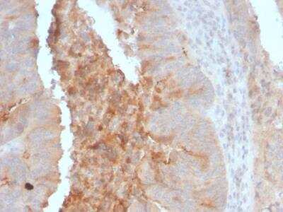 Immunohistochemistry-Paraffin: ECM-1/Secretory Component P85 Antibody (rECM1/792) - IHC-Prediluted [NBP2-48176] - Formalin-fixed, paraffin-embedded human Colon Carcinoma stained with IgA Secretory Component Mouse Monoclonal Antibody (ECM1/792).