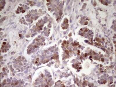 Immunohistochemistry: ECT2 Antibody (OTI2D9) - Azide and BSA Free [NBP2-70613] - Analysis of Adenocarcinoma of Human ovary tissue. (Heat-induced epitope retrieval by 1 mM EDTA in 10mM Tris, pH8.5, 120C for 3min)