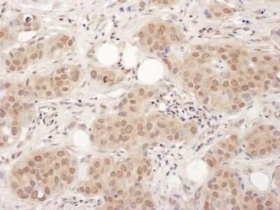 <b>Biological Strategies Validation. </b>Immunohistochemistry: EDF1 Antibody [NBP2-22327] - Sample: FFPE section of human breast carcinoma. Antibody: Affinity purified rabbit anti- EDF-1 used at a dilution of 1:1,000 (1ug/ml). Detection: DAB. Counterstain: IHC Hematoxylin (blue).